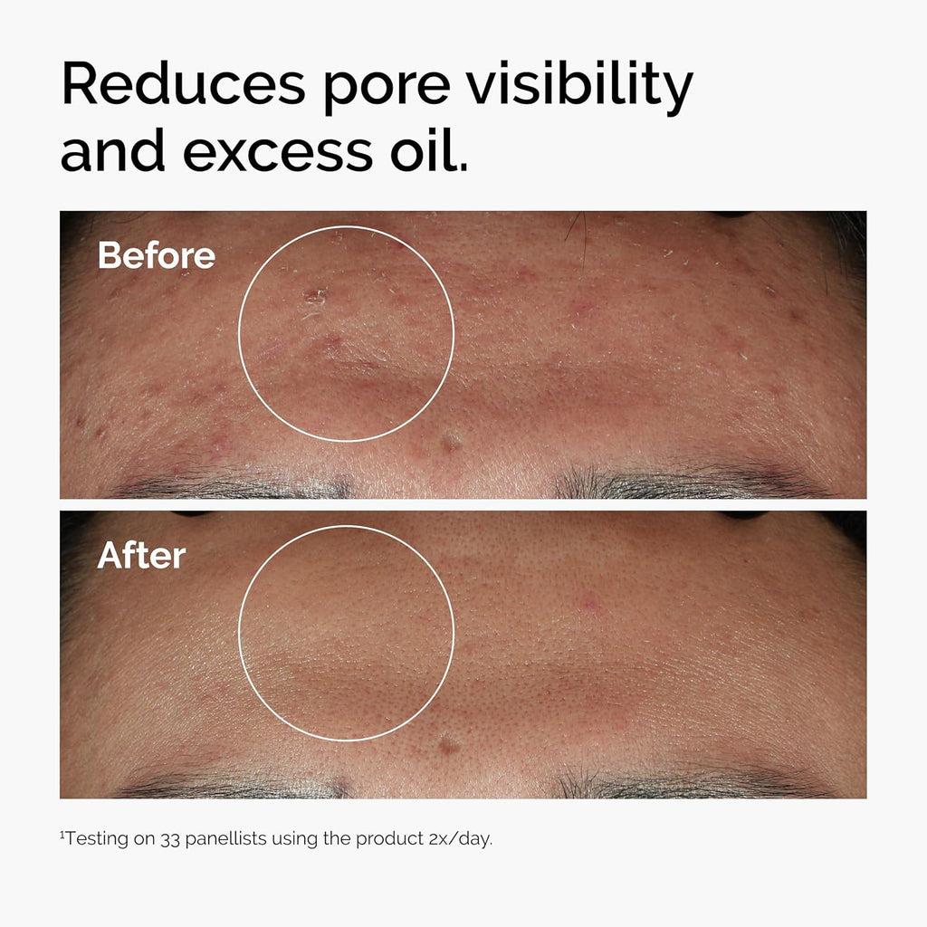 The Ordinary Niacinamide 10% + Zinc 1%, sérum éclat et lissant pour peaux à imperfections, 30 ml